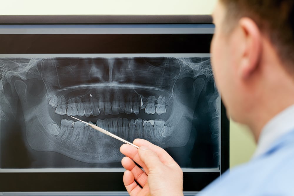 Digital X-Rays - Shalimar Family Dentistry