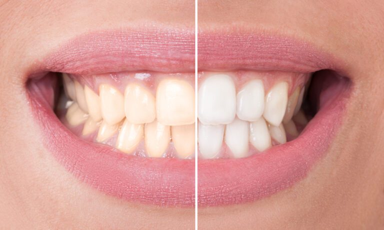 Teeth Whitening in Tempe