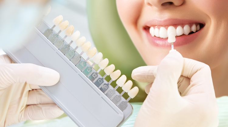 Close-up of a dentist holding a shade guide next to a patient's teeth to match the color for dental veneers or crowns, showcasing a bright and healthy smile