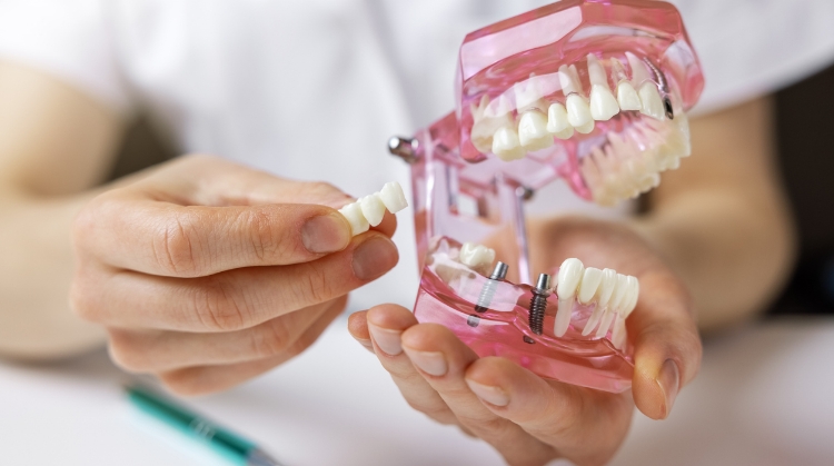 Dental model showing implants with attached artificial teeth.